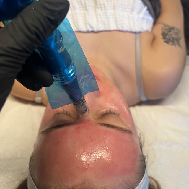 Microneedling Package of 3 at Skin Savvy Spokane in Spokane, WA